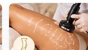 Tratamiento de lipocelulitis en piernas en Key Natural Glow Bucaramanga